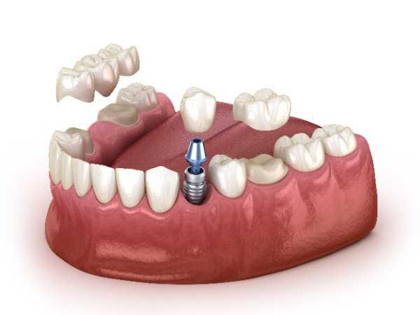 dental implants Manchester