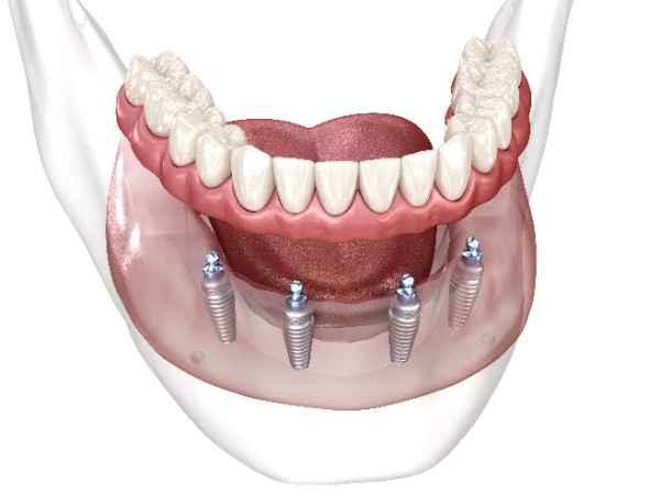 dental implant Wigan